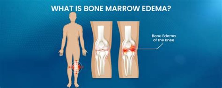 BME Pain: Understanding And Managing Pain In BME (Bone Marrow Edema)