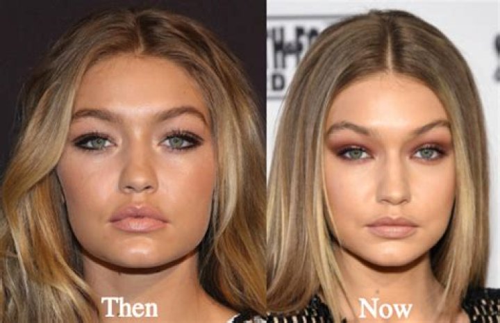 Did Gigi Hadid Get Plastic Surgery?