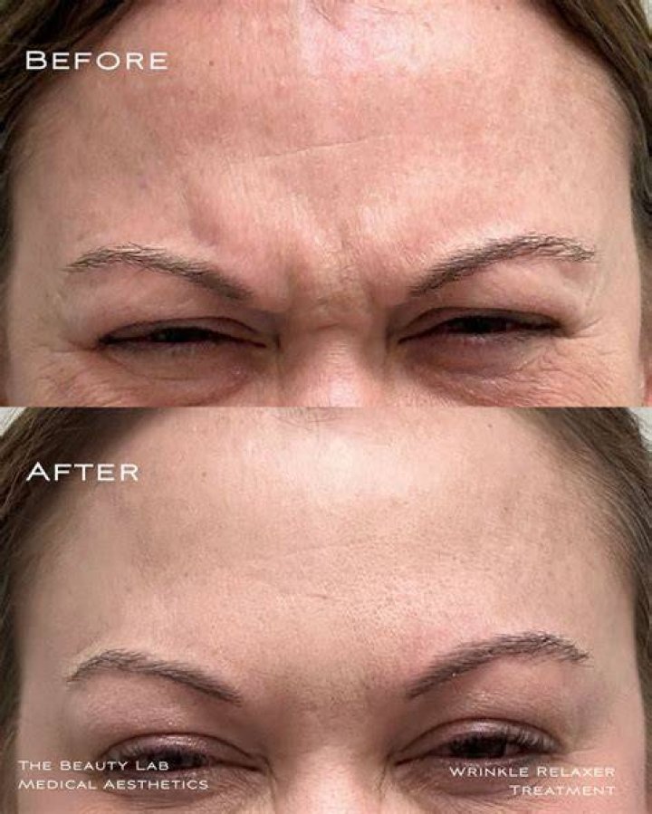 Does deep wrinkle filler work?