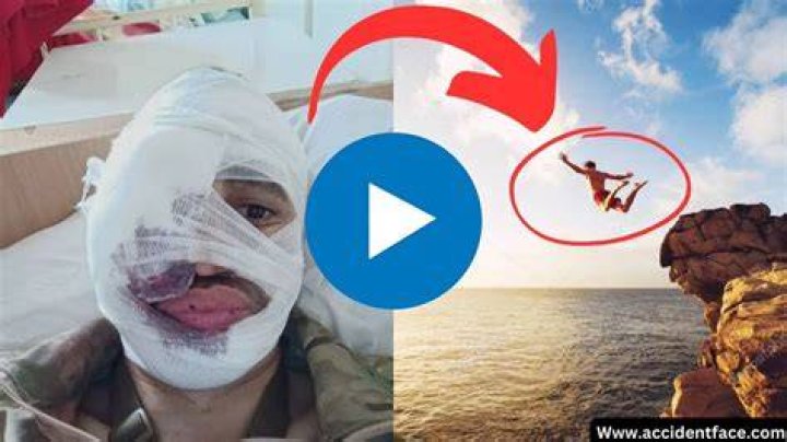 Face Split Diving Accident &raquo; Otaewns