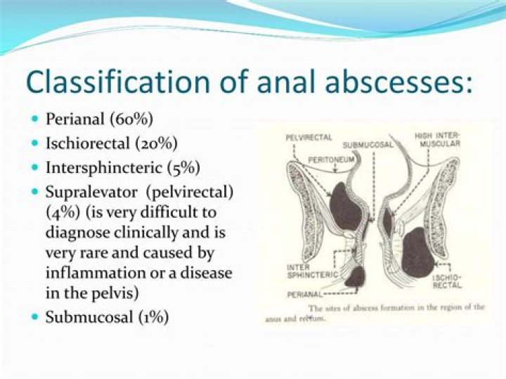 How Long Do Peri-anal Abscesses Drain?