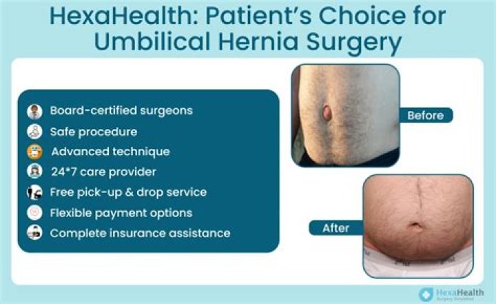 How Long Hospital For Peri Umbilical Hernia? (Solution)
