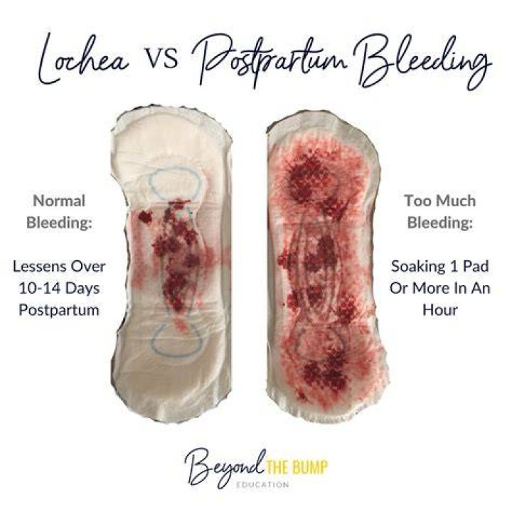 How Many Peri Pads Soaked Indicate Postpartum Hemorrhage? (Solved)