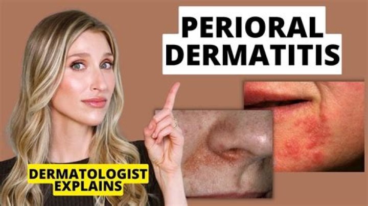 How To Heal Peri Oral Dermatitis Quickly?
