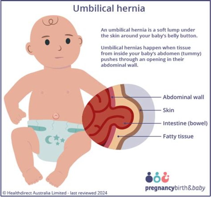 How To Treat Peri-umbilical Hernia? (Solution found)