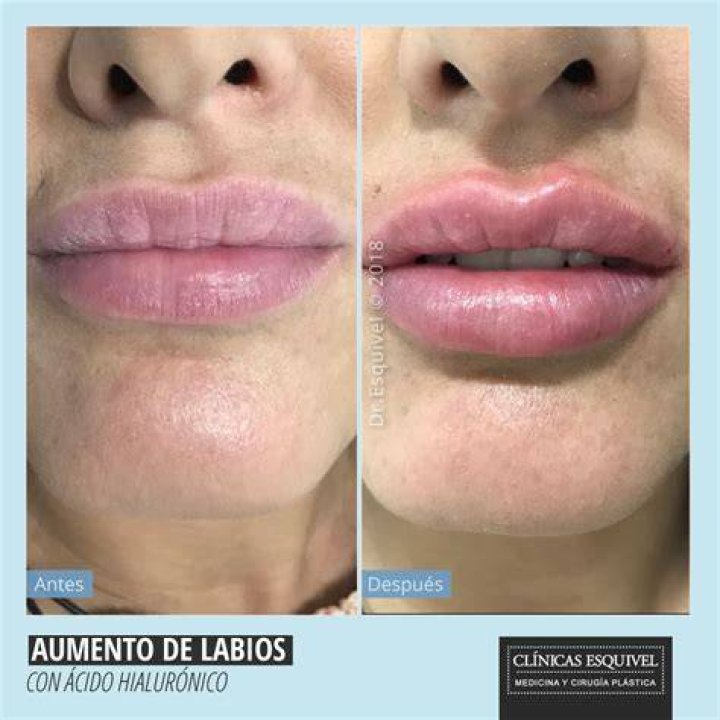 Recuperación y cuidados tras un aumento de labios