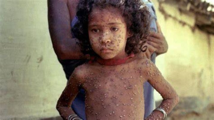 Smallpox sufferer