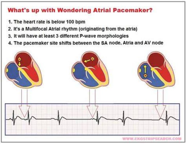What causes a wandering pacemaker?