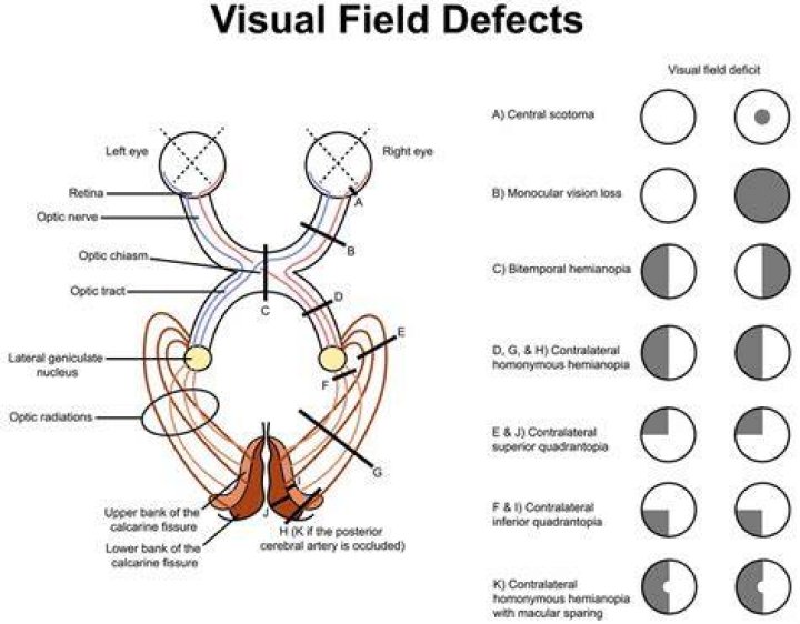 What causes left superior quadrantanopia?