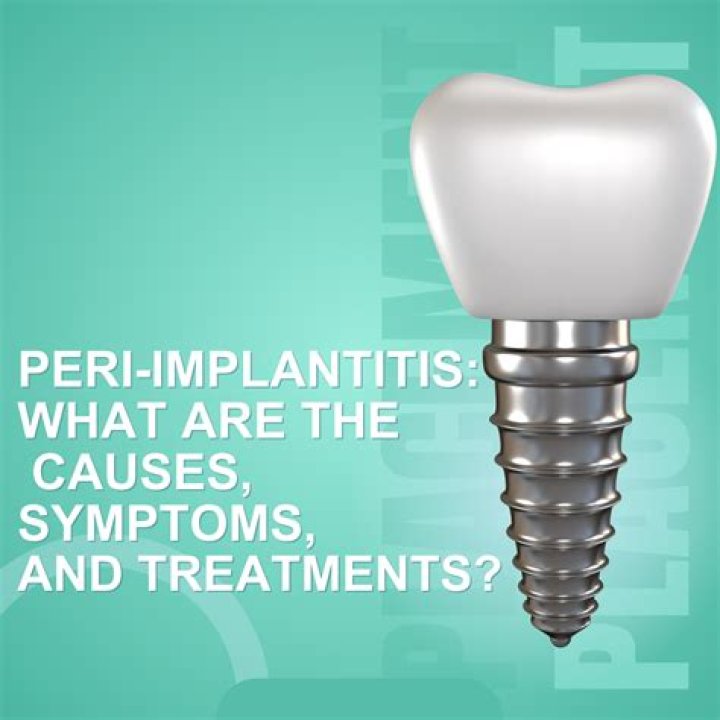What Causes Peri Implantitis? (Correct answer)