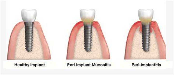 What Causes Peri-implantitits? (Solution found)