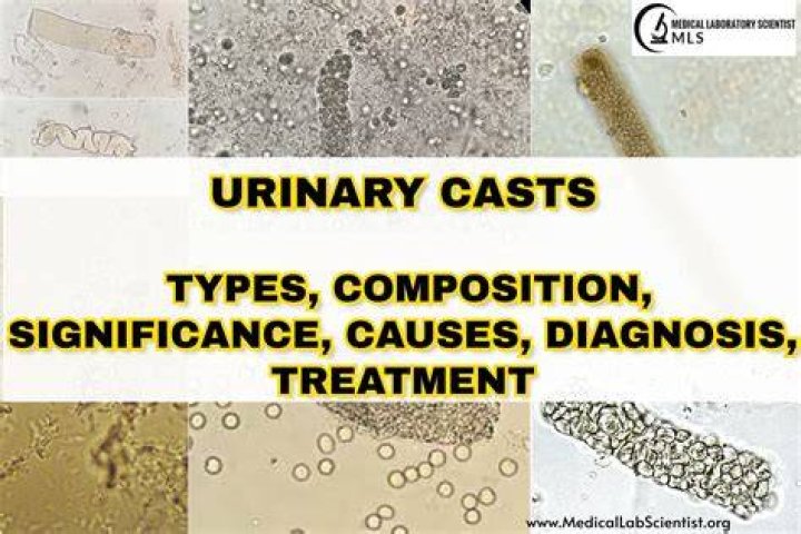 What do casts in the urine indicate?