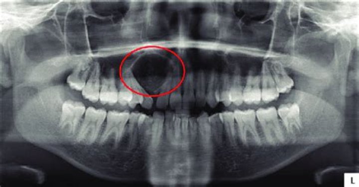 What does well-Corticated mean?