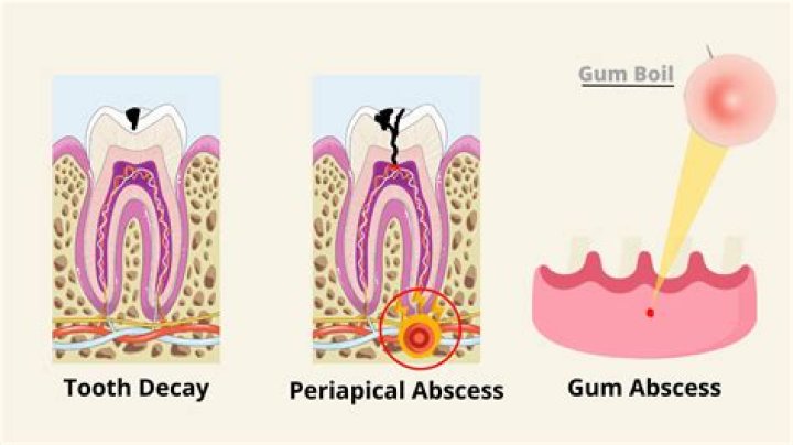 What Is A Peri Abcess Boil? (Solved)