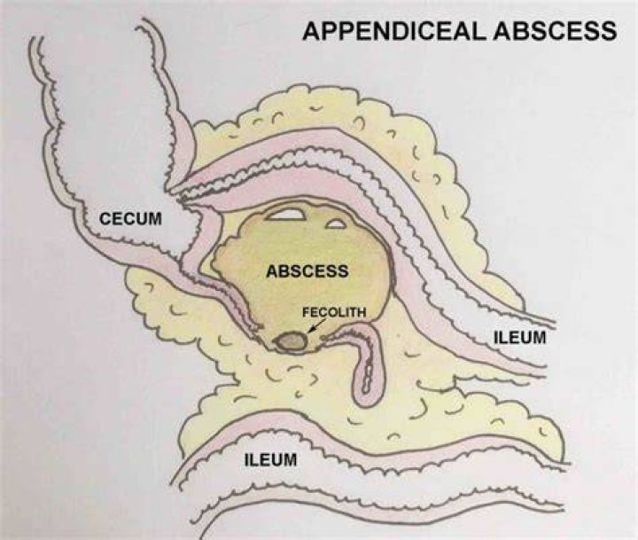 What Is A Peri-appendicular Abscess?