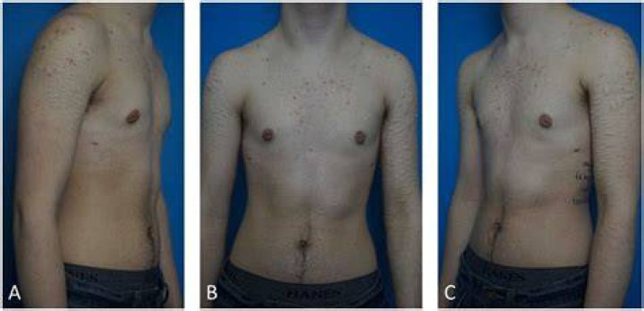 What Is A Peri Areolar Mastectomy? (Question)
