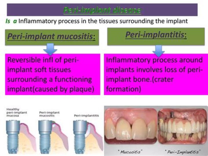 What Is A Peri Implant Defect? (Solution)