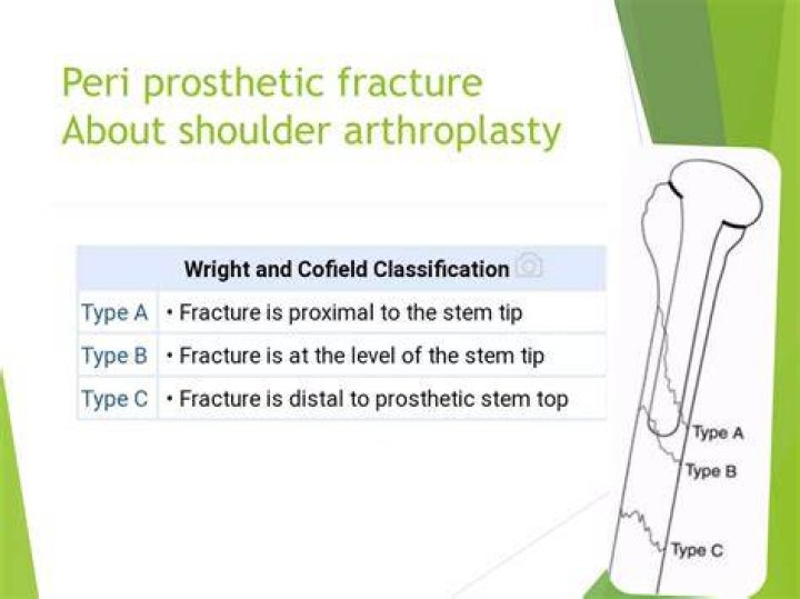 What Is A Peri Prothetic Fracture? (Solution)