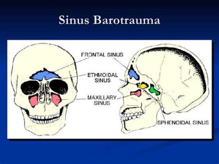 What is a sinus barotrauma after flying?