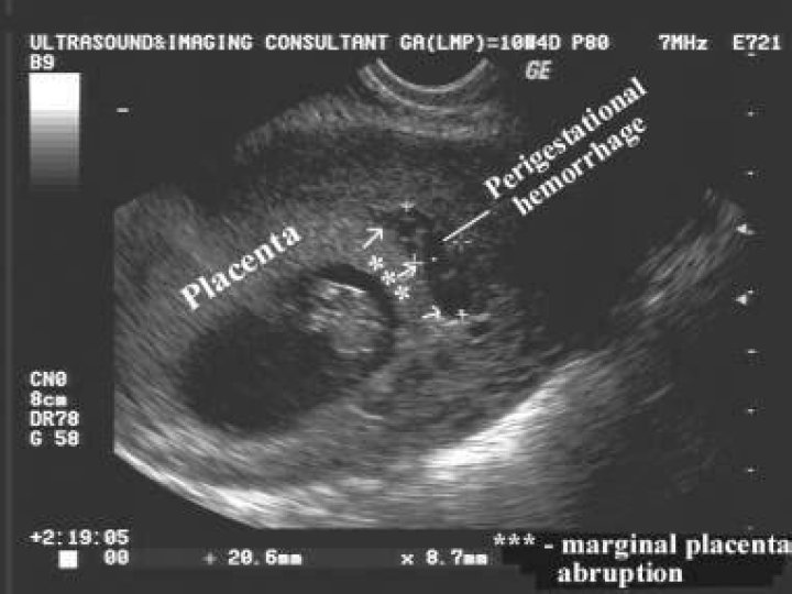 What Is Peri Gestational Hemmorage? (Perfect answer)