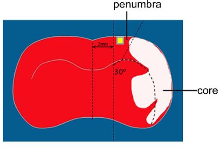 What Is Peri-infarct Mean? (Solution found)