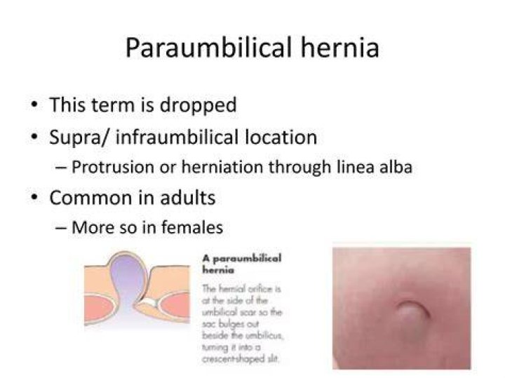 What Is Supra / Peri Umbilical? (Solution)