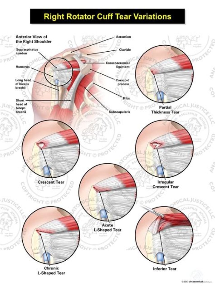 What is the ICD 10 code for supraspinatus tear?