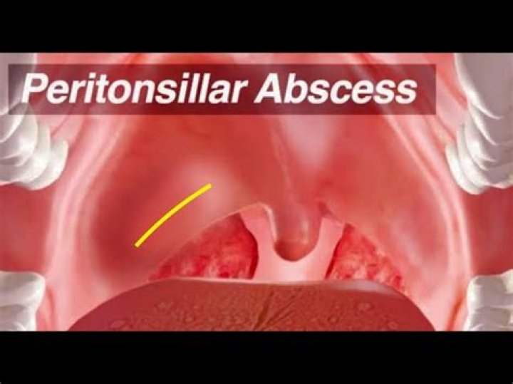 What Is The Icd 10 For Peri Tonsillar Abcess? (Solved)