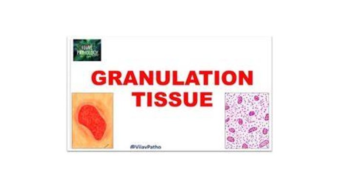 What Is Traumatic Peri-annular Active Granulation L3? (Perfect answer)