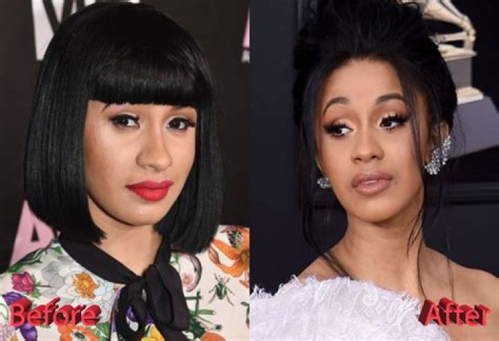What Plastic Surgery Has Cardi B Gotten?