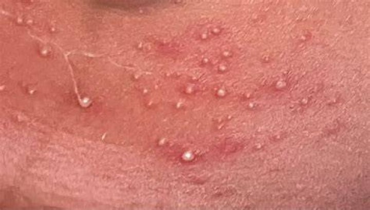 When To Call For Bumps On Peri Area? (Perfect answer)