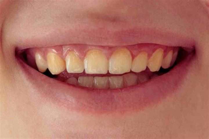 Why do swimmers have yellow teeth?