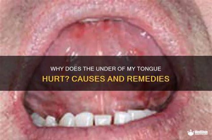 Why Does Hot Sauce Hurt My Tongue? (Solution found)